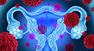 8 باور نادرست درباره آندومتریوز